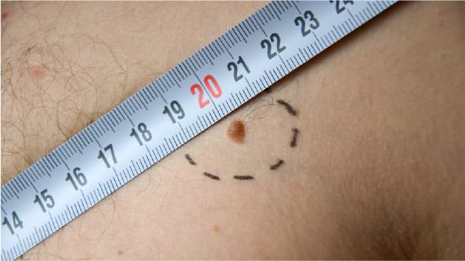 Skin Cancer Staging